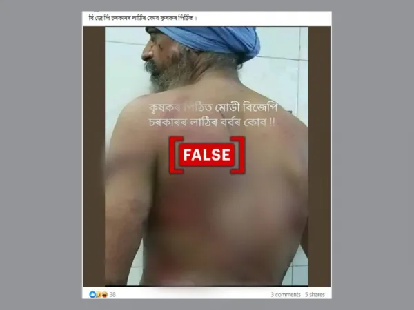 Photo of man in turban with bruises on his back falsely linked to Indian farmers’ protest